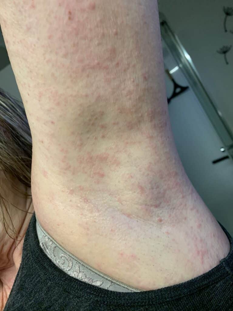 Histamine rash